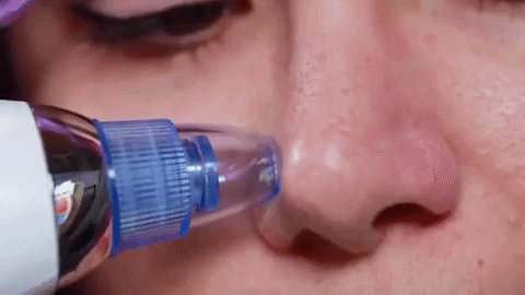 Derma Suction – Professional Pore Cleaner & Blackhead Remover Vacuum