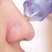 Derma Suction – Professional Pore Cleaner & Blackhead Remover Vacuum